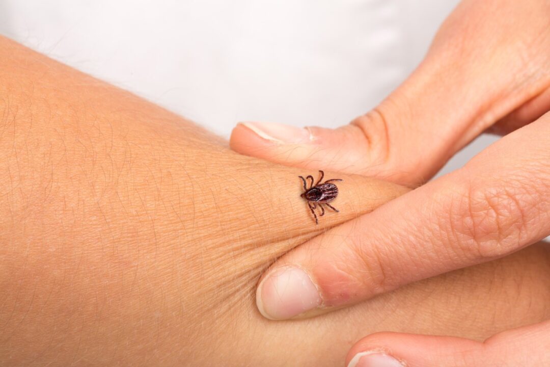 Can A Tick Bite Give Me A Meat Allergy , Health Channel