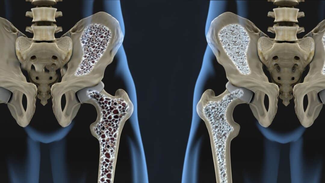 How can I prevent osteoporosis?