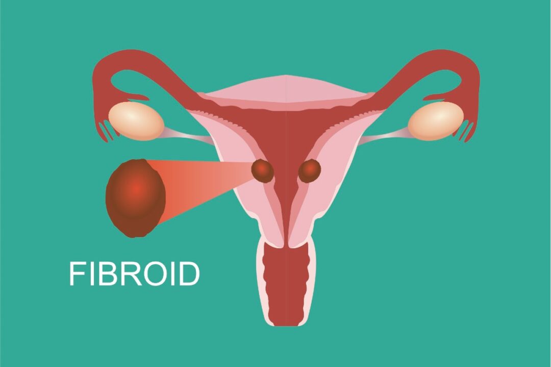 What Are Treatment Options For Uterine Fibroids  1, Health Channel