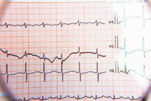 What Does Or Doesnt An Electrocardiogram Say  300x200, Health Channel