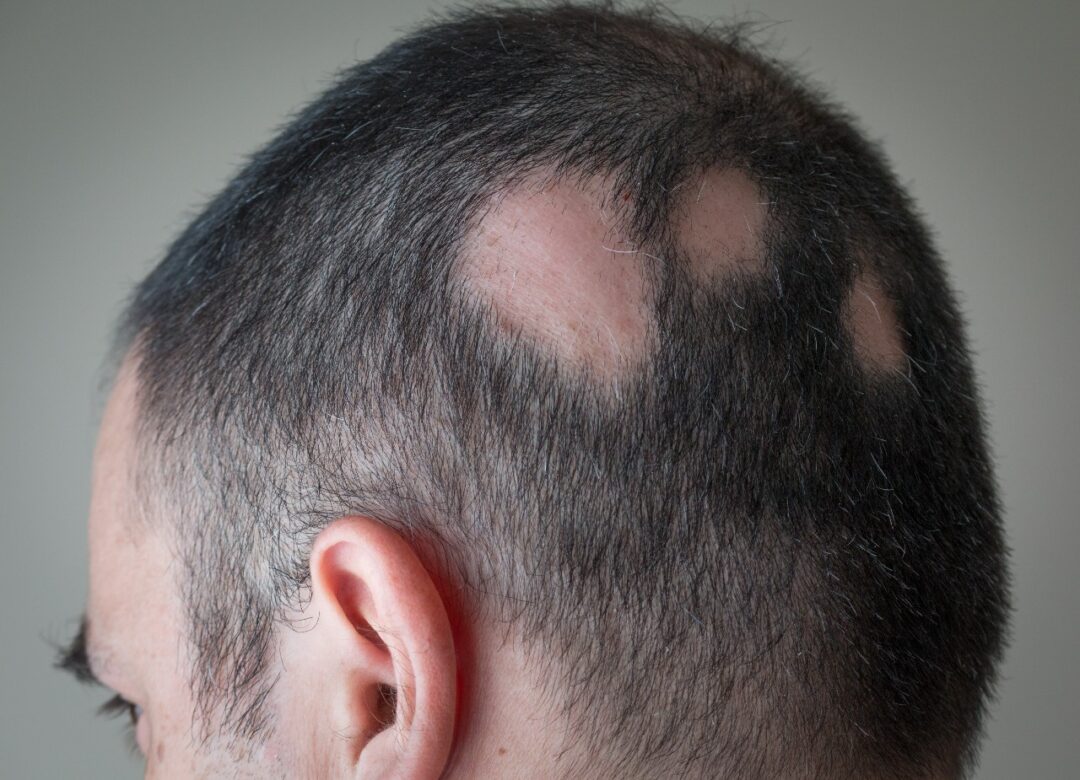 What Is Alopecia Areata , Health Channel