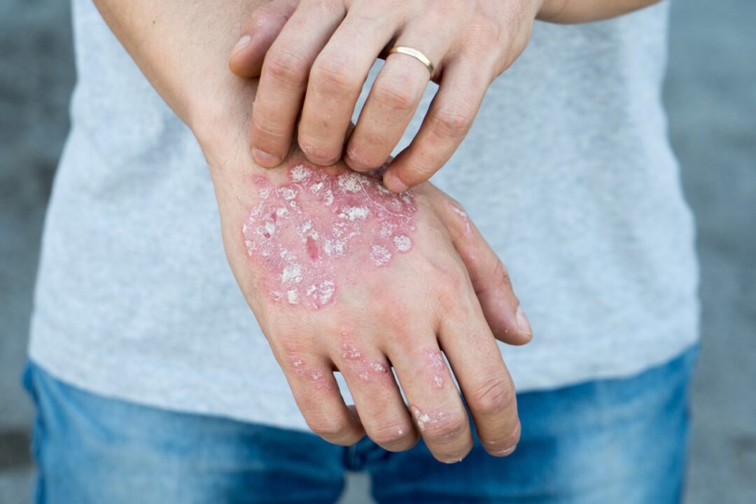 What Is Psoriasis , Health Channel