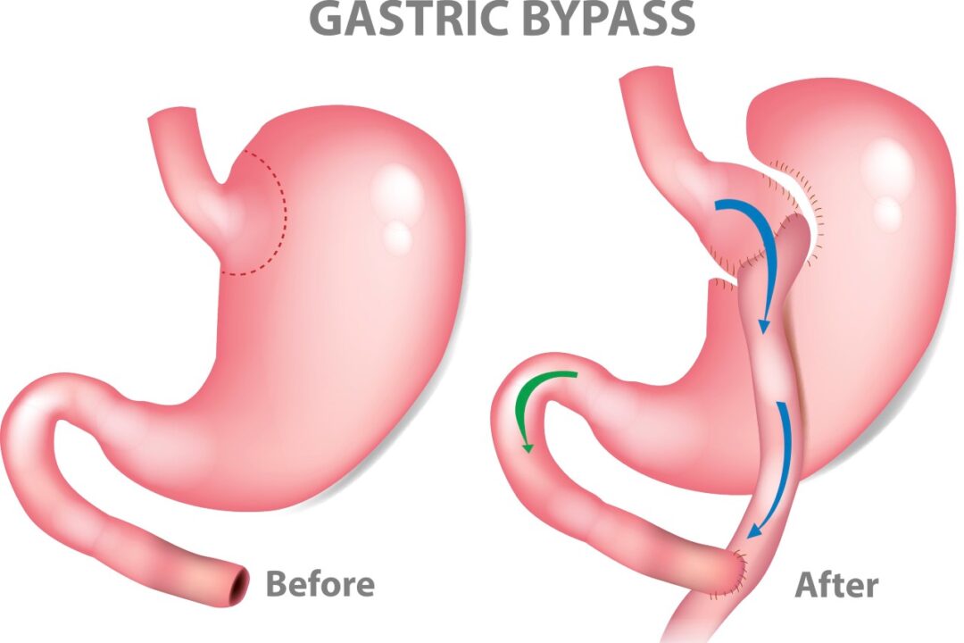 When is Gastric Bypass surgery a good option?