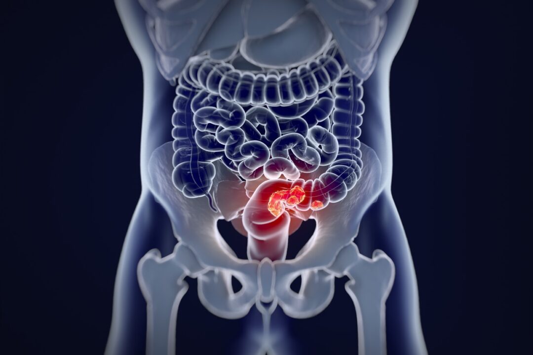 Is Colorectal Cancer Screening Effective , Health Channel
