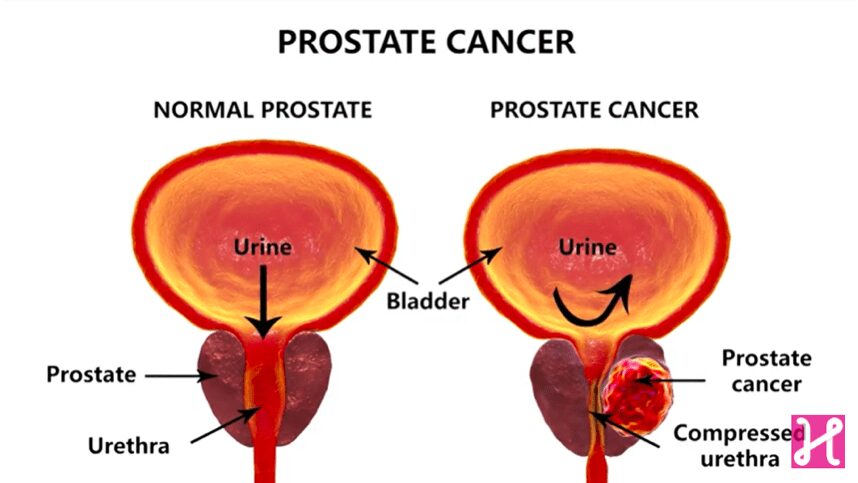 Understanding Prostate Cancer, Health Channel